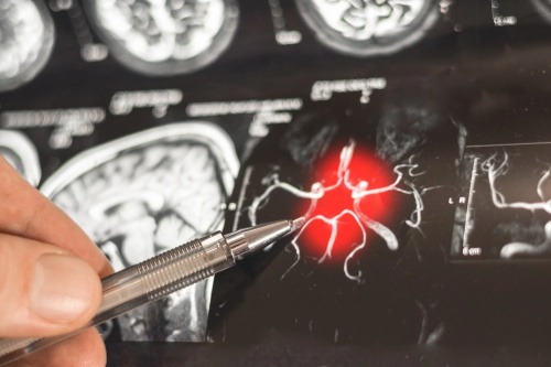 A doctor pointing to a highlighted area on a brain angiogram scan, indicating a potential issue